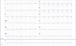 Miniatura obrazu 3 przedstawiająca badanie EKG 