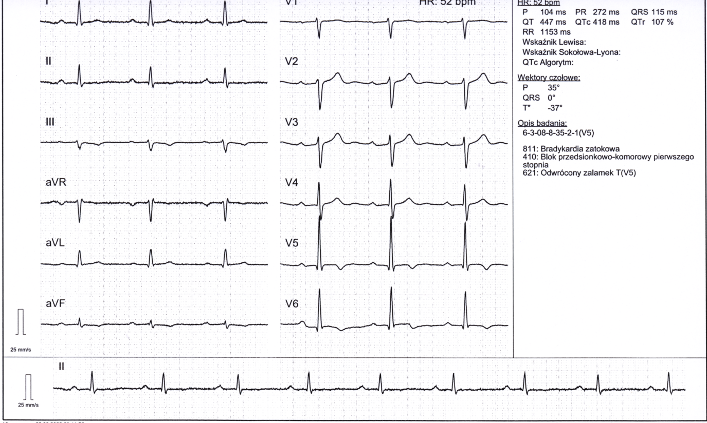 Przykład obrazu badania EKG