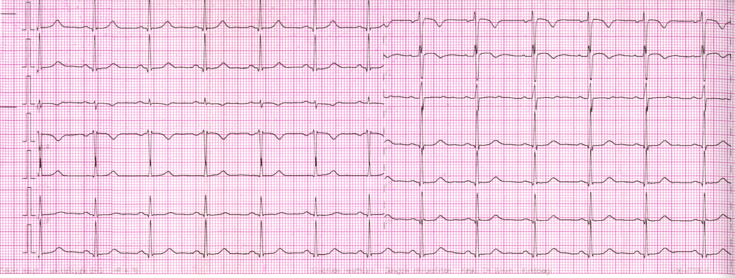 Przykład obrazu badania EKG