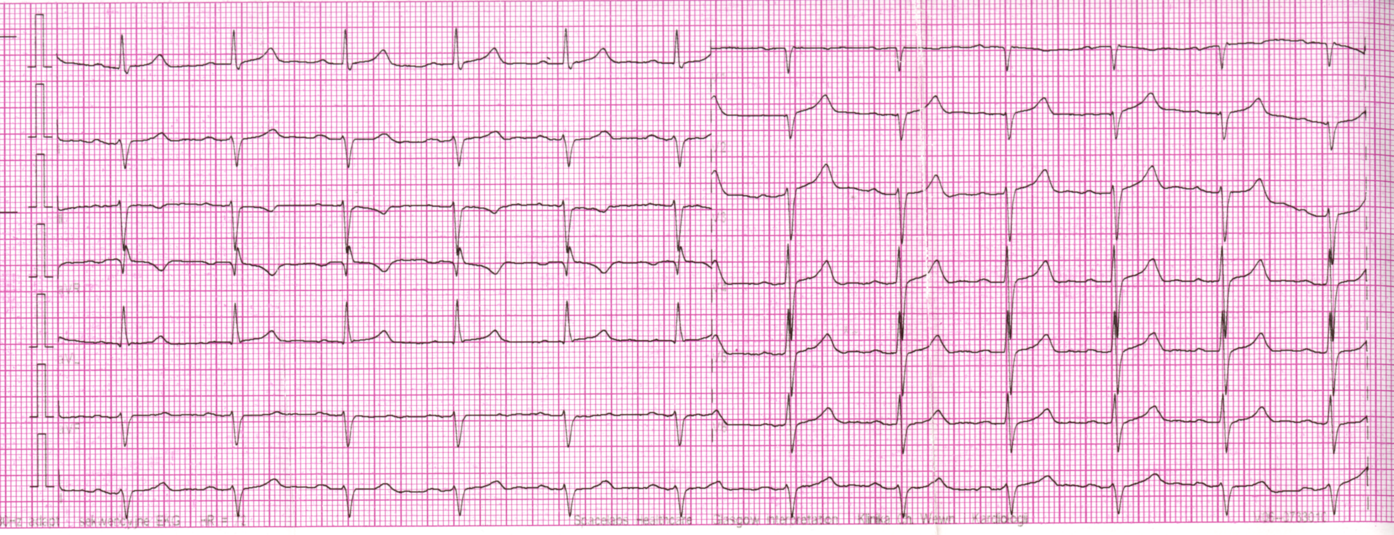 Przykład obrazu badania EKG