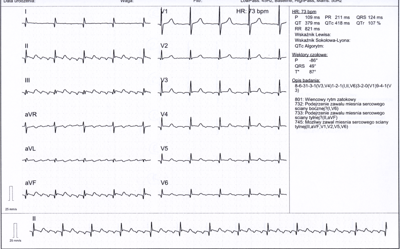 Przykład obrazu badania EKG