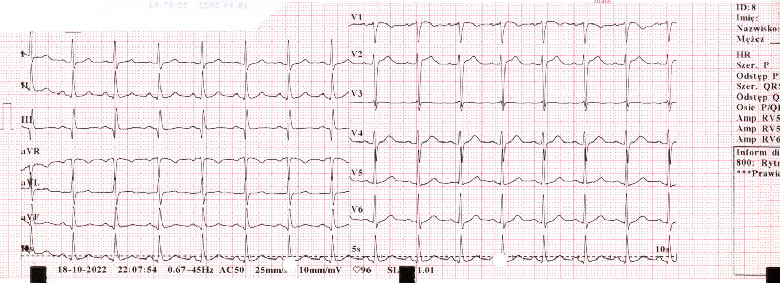 Przykład obrazu badania EKG