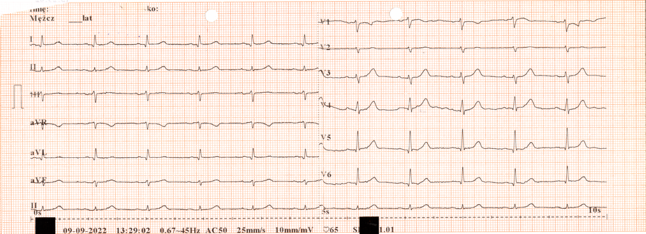 Przykład obrazu badania EKG