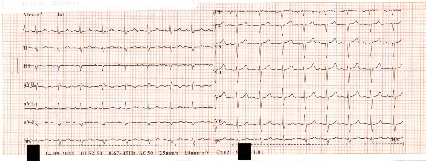 Przykład obrazu badania EKG