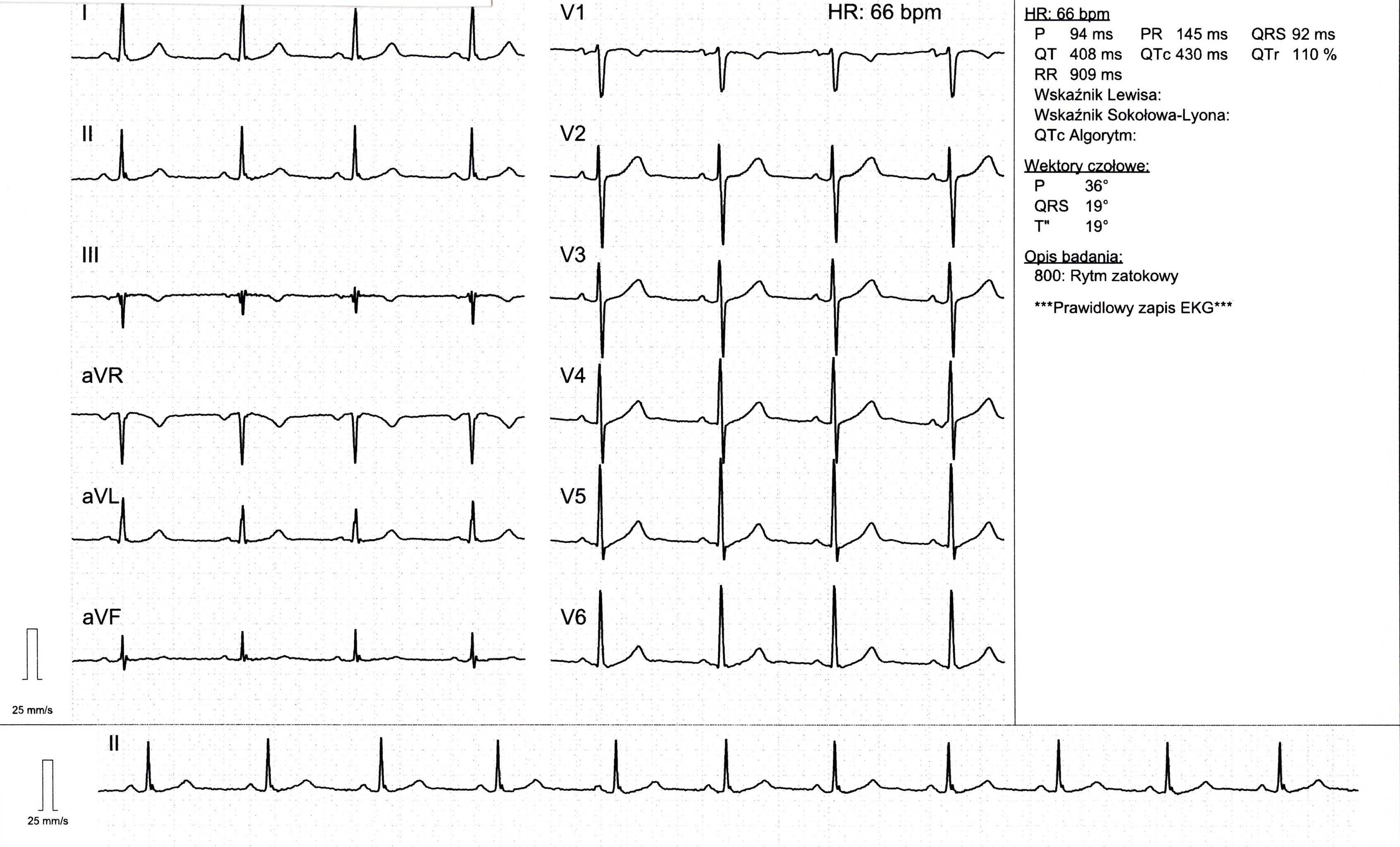 Przykład obrazu badania EKG