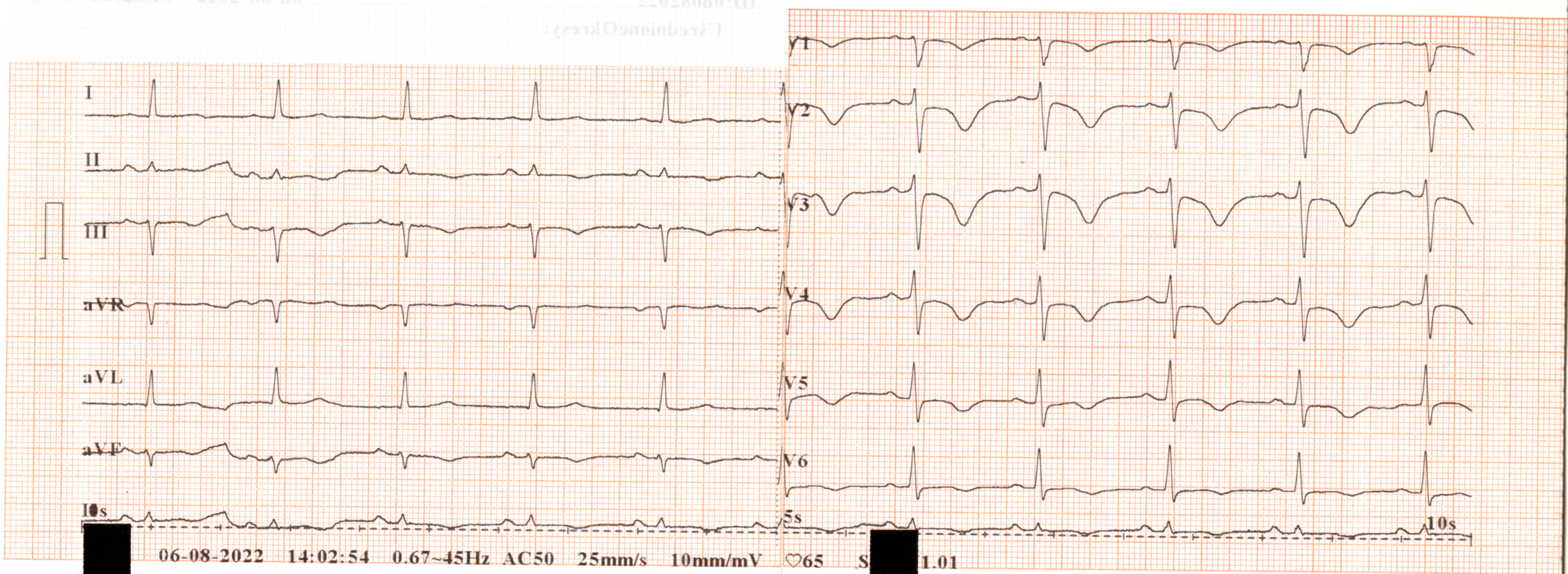 Przykład obrazu badania EKG